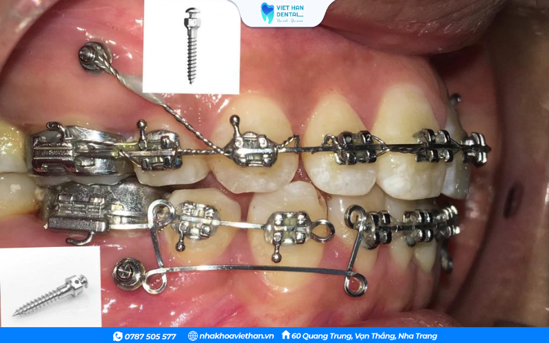 Cắm minivis để hỗ trợ chỉnh nha