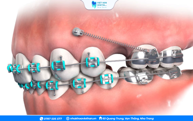 Mô phỏng kỹ thuật đánh lún răng