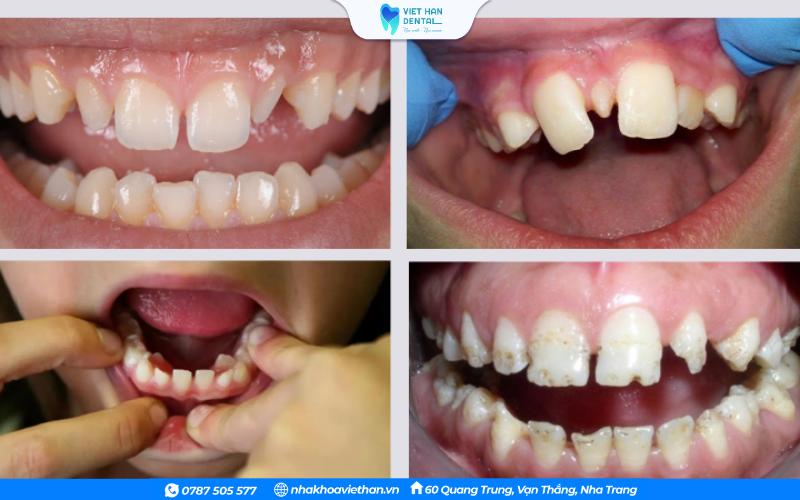 Tình trạng răng nhỏ bất thường so với xương hàm