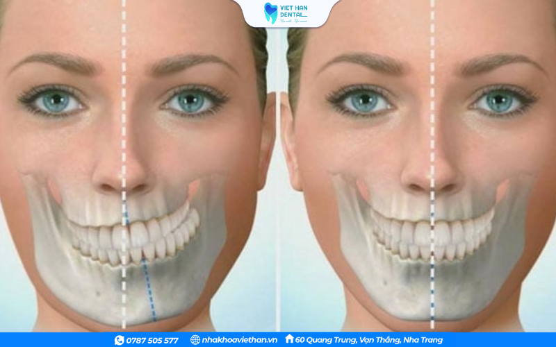 Một số người sinh ra đã có sự phát triển xương hàm bất cân đối