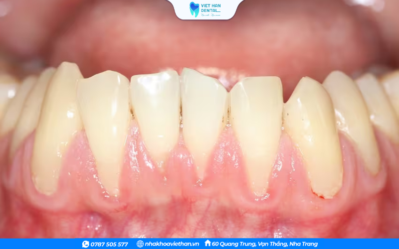 Nướu bị sưng tấy, không ôm sát chân răng là dấu hiệu của tụt lợi