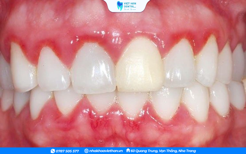 Viêm nướu có thể dẫn đến chảy máu chân răng
