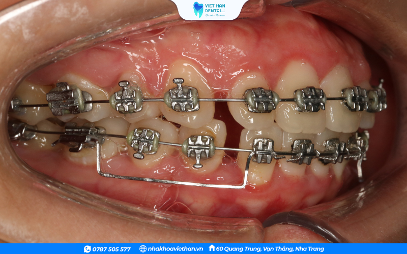Niềng ra một biện pháp giúp cải thiện tình trạng răng hô nhẹ