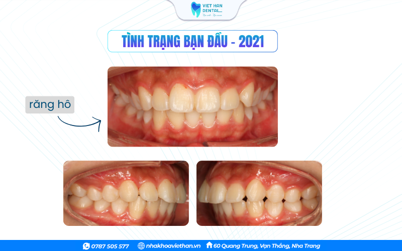 Khách hàng có tình trạng răng hô trước khi niềng răng tại Nha khoa Việt Hàn