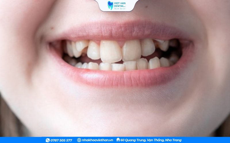 Một số thói quen xấu từ nhỏ có thể dẫn đến tình trạng răng khấp khểnh