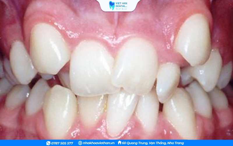Nhổ răng lòi xỉ là không cần thiết