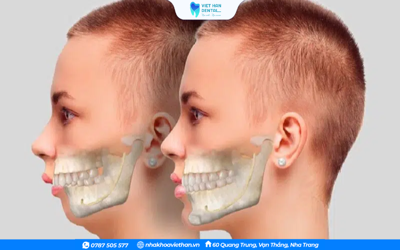 Mất cân đối giữa chiều dài xương hai hàm khiến cung răng không khớp đều