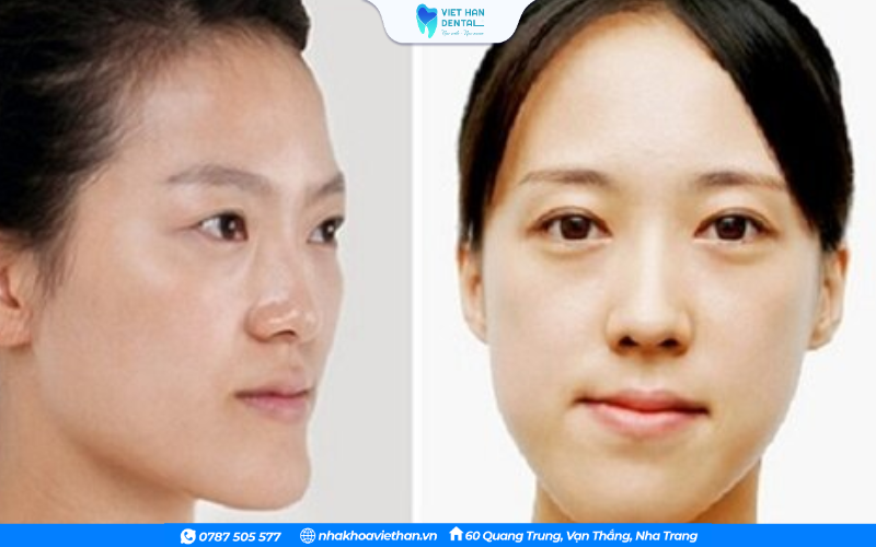 Hàm bị lệch
