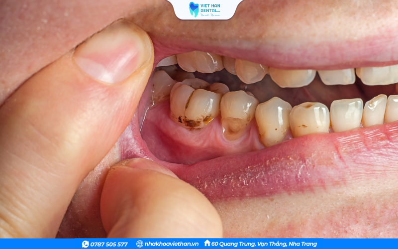 Những vùng men răng bị tổn thương tạo điều kiện cho vi khuẩn phát triển, gây sâu răng nhanh hơn
