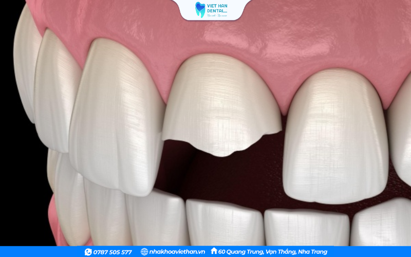 Răng bị mẻ, gãy lớn dẫn đến mất thẩm mỹ