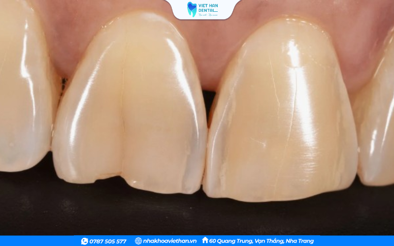 Răng bị nứt vỡ là một trong các dấu hiệt của mòn men răng