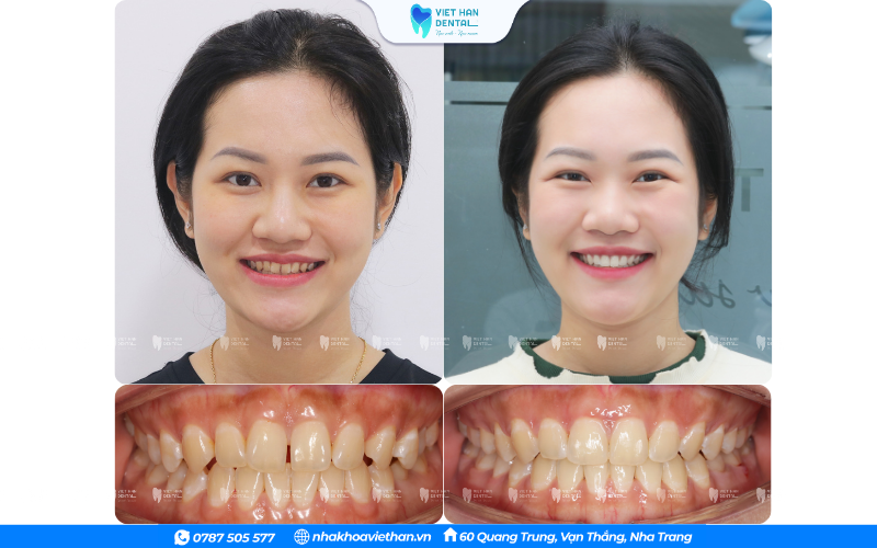 Niềng răng là phương pháp chỉnh nha tiên tiến nhận được nhiều đánh giá tích cực