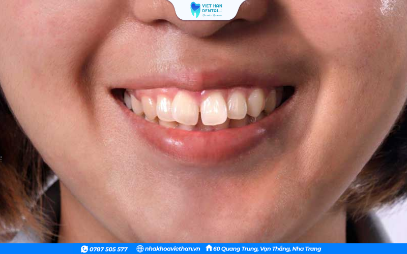 Không nên bọc răng sứ để khác phục tình trạng răng hô