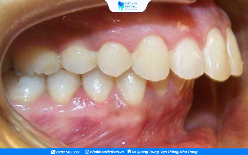Sai lệch khớp cắn ảnh hưởng đến khả năng cắn và nghiền thức ăn