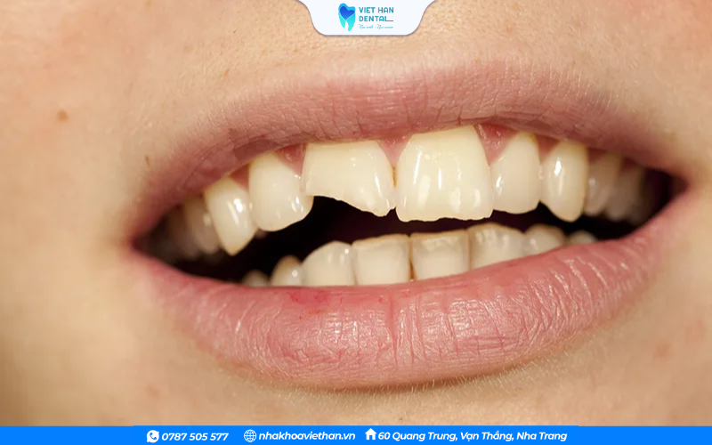 Thói quen cắn vật cứng có thể dẫn đến mẻ vỡ răng