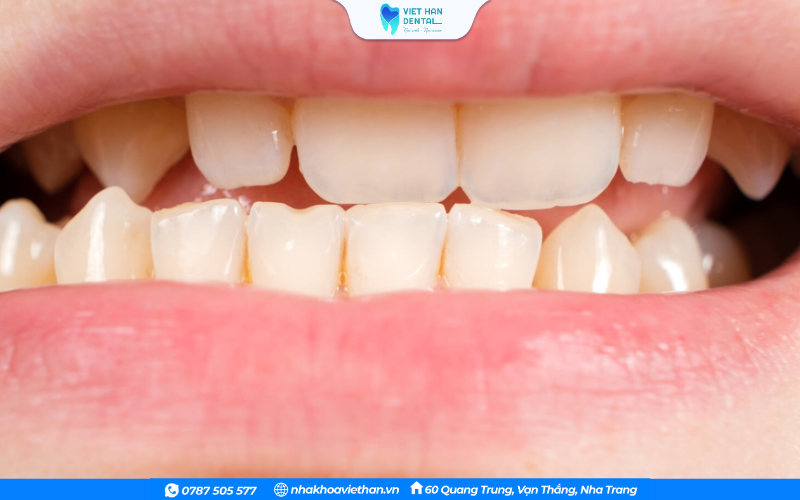 Hàm dưới phát triển quá mức hoặc hàm trên kém phát triển dẫn đến lệch khớp cắn