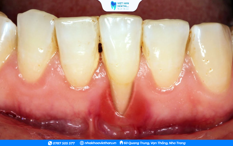 Tụt lợi dẫn đến mất răng