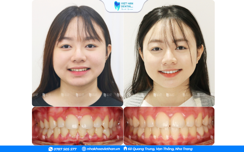 Hình anh khách hàng trước và sau khi niềng răng mắc cài tại Nha khoa Việt Hàn