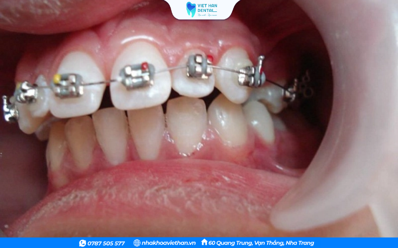 Niềng răng điều trị răng hô