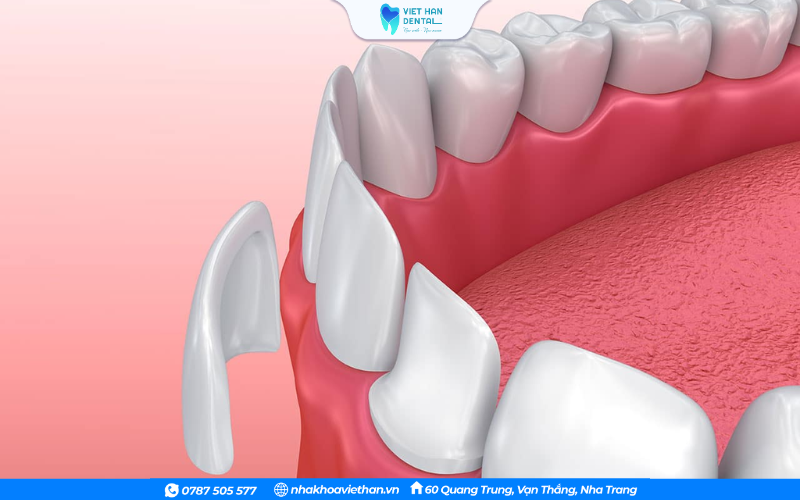 Phương pháp dán sứ Veneer