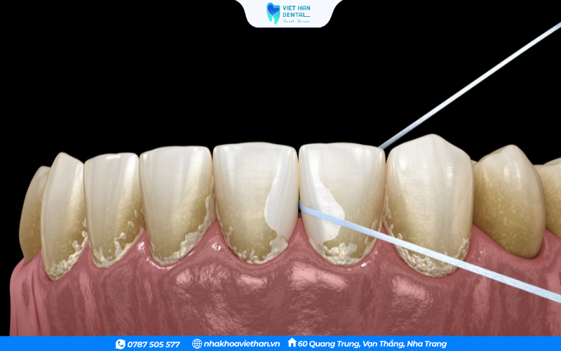 Dùng chỉ nha khoa để loại bỏ thức ăn thừa trên răng