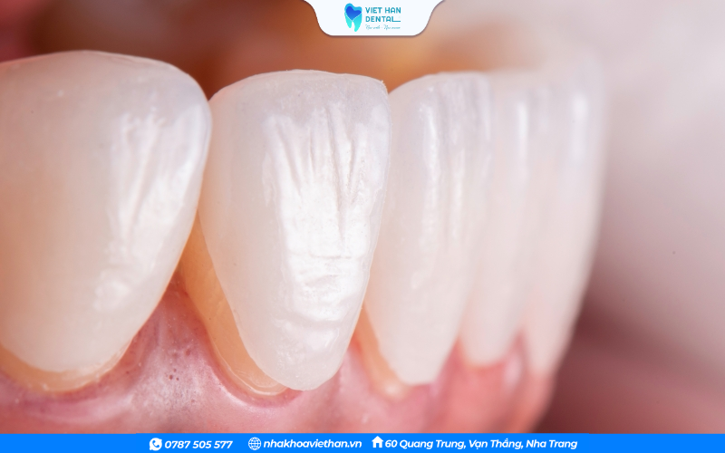 Dán sứ thẩm mỹ Veneer có thể khắc phục được tình trạng mòn men răng