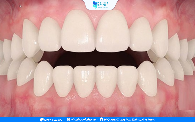 CÓ hàm răng bị khớp cắn hở khiến người bệnh cảm thấy thiếu tự tin
