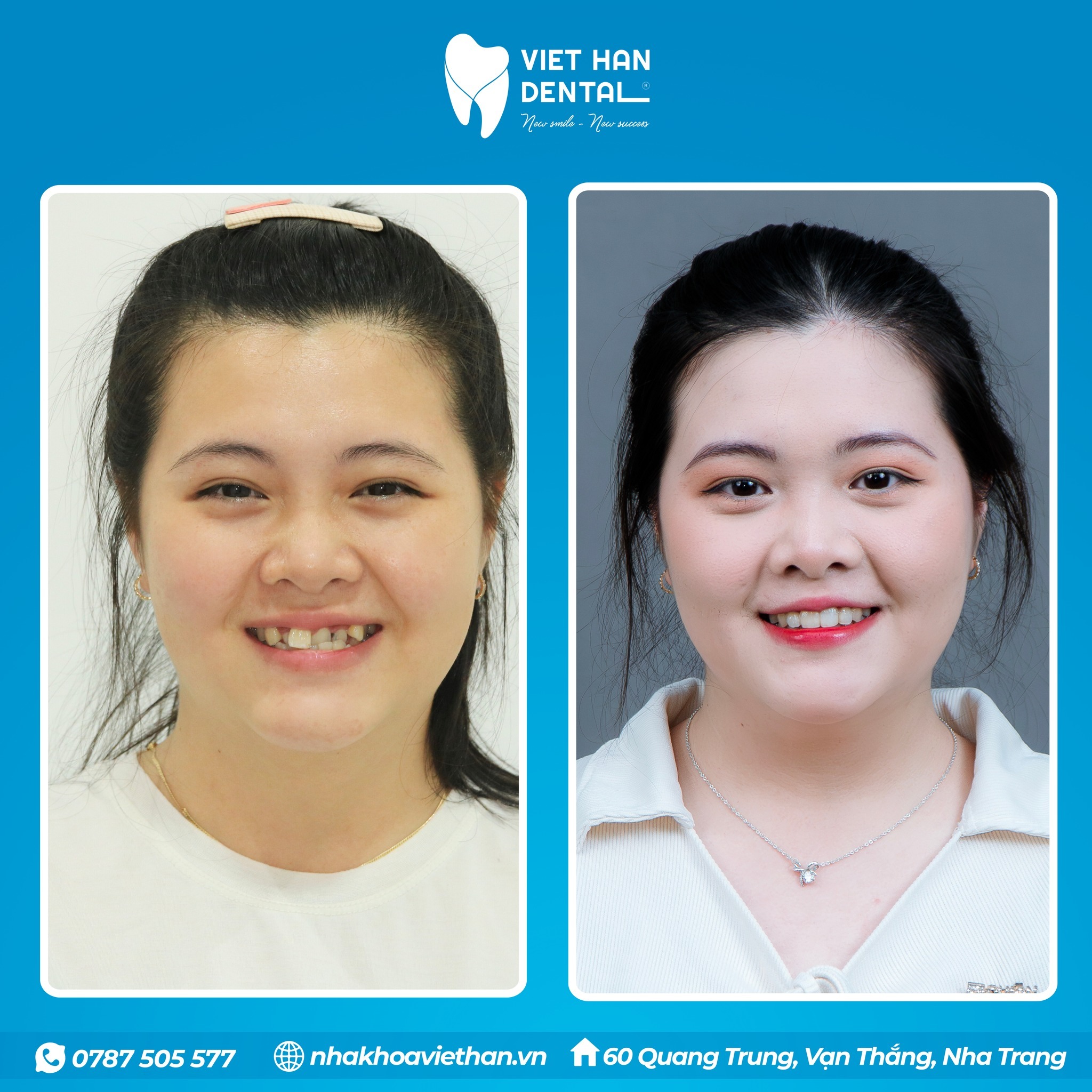 Khách hàng trước và sau khi niềng răng tại Nha khoa Việt Hàn