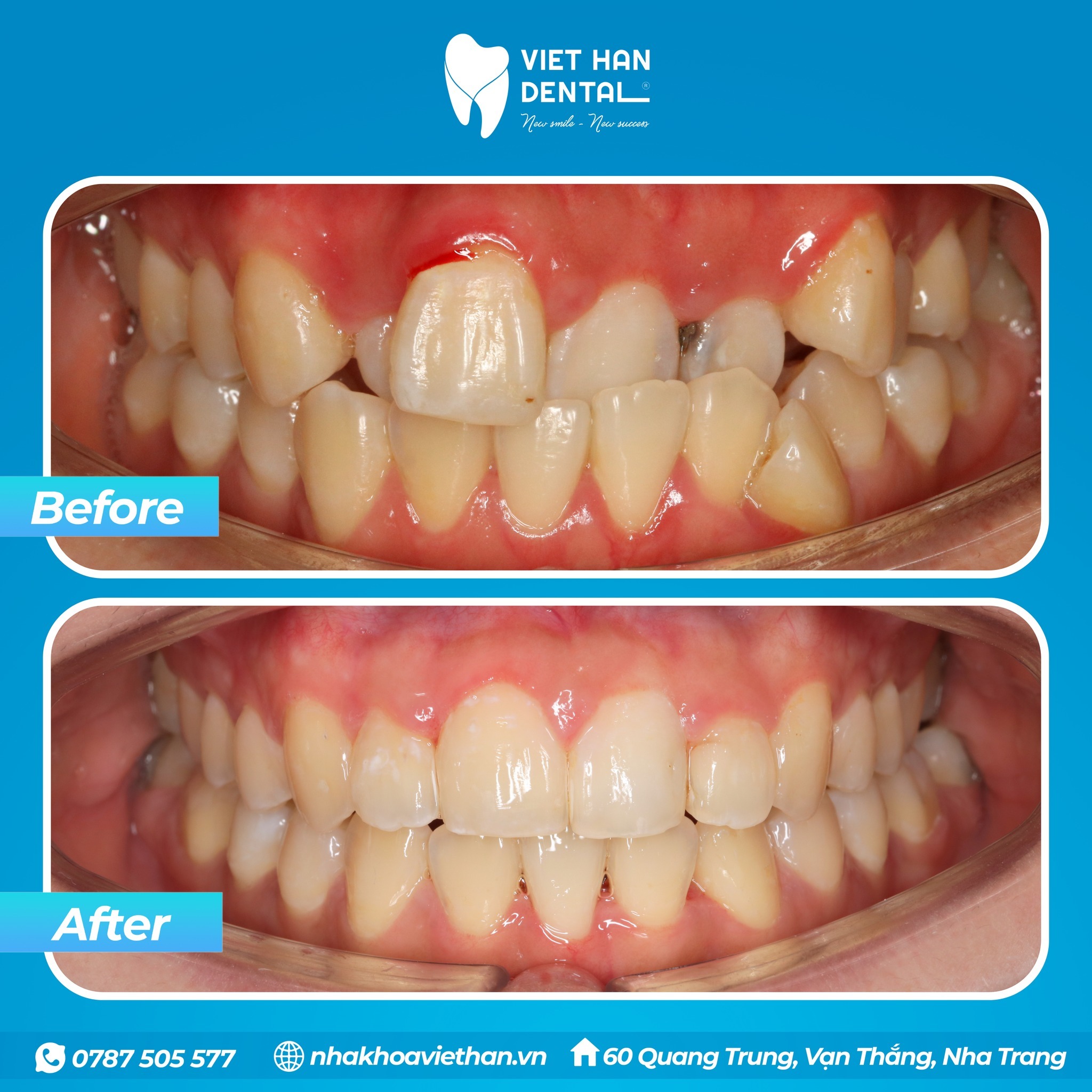 Hình ảnh răng của khách hàng trước và sau khi niềng răng tại Nha khoa Việt Hàn