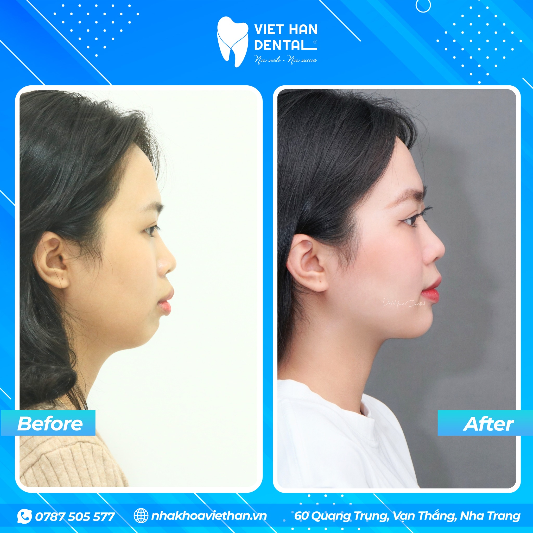 Góc nghiêng của khách hàng trước và sau khi niềng răng tại Nha khoa Việt Hàn