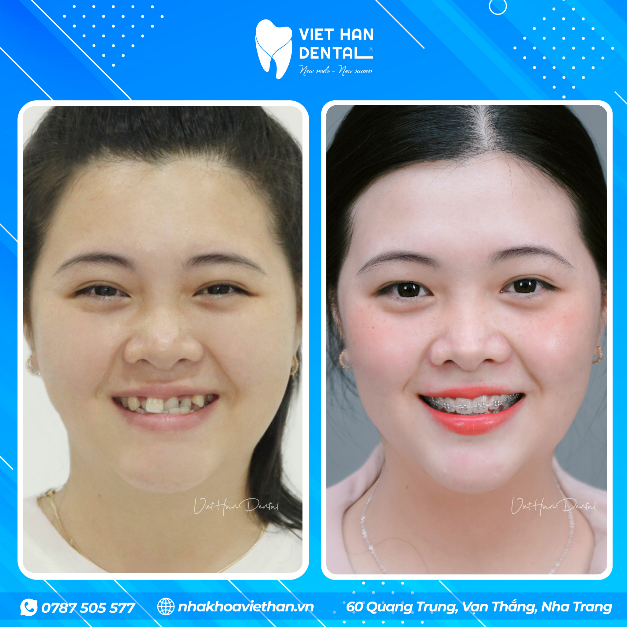 Khách hàng trước và trong quá trình đeo niềng răng tại Nha khoa Việt Hàn