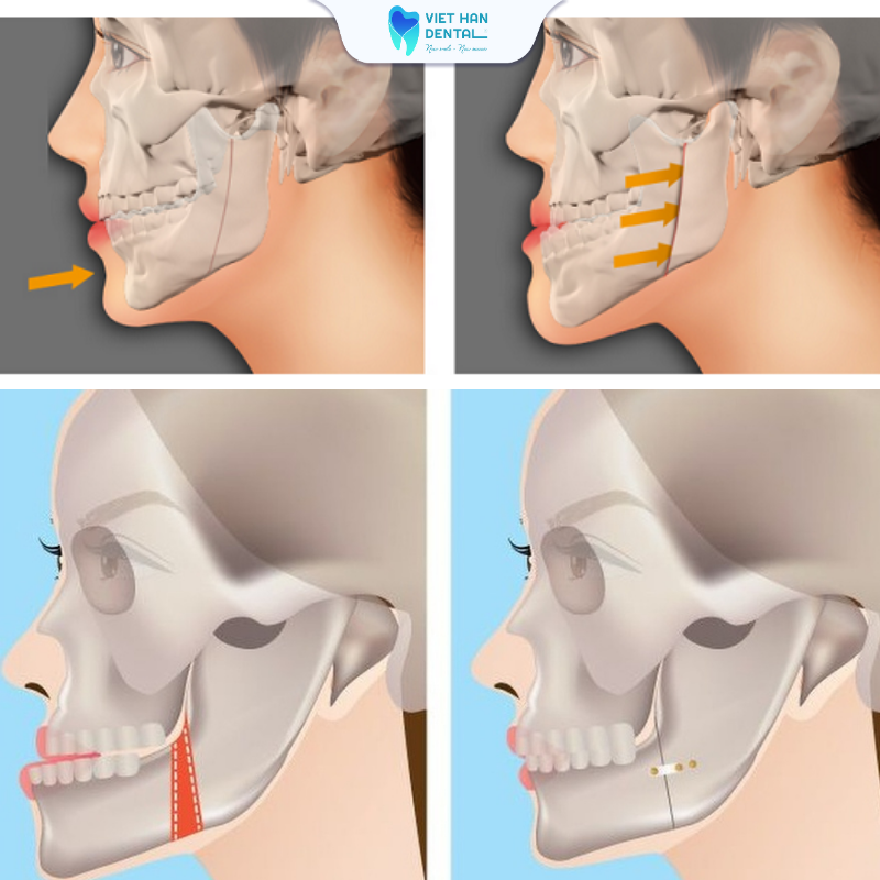 Trường hợp lệch hàm can thiệp phẫu thuật