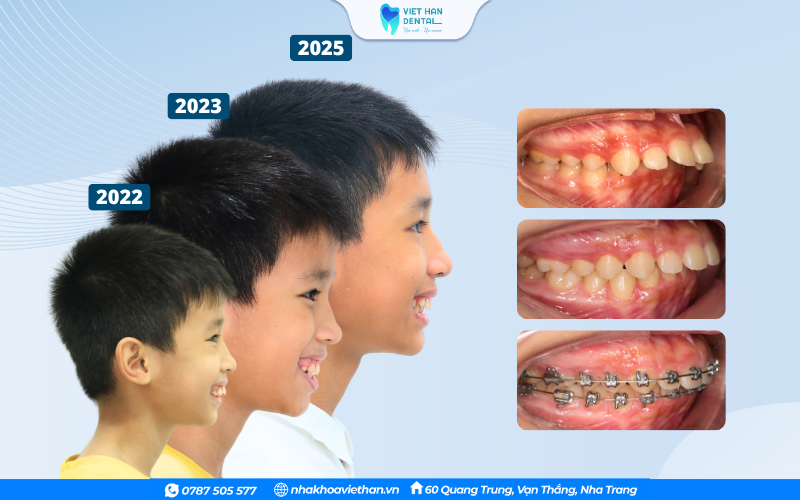 Quá trình niềng răng tăng trưởng của trẻ tại Nha khoa Việt Hàn