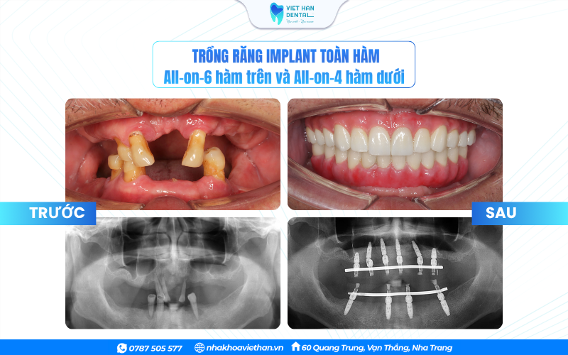 Khách hàng trước và sau trồng răng Implant toàn hàm tại Nha khoa Việt Hàn
