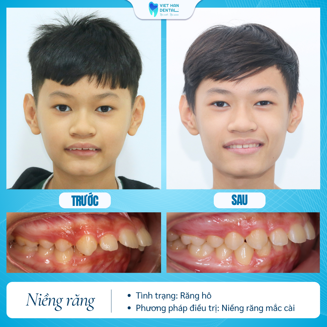 Khách hàng trước và sau khi chỉnh nha tăng trưởng tại Nha khoa Việt Hàn