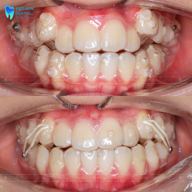 Niềng răng trong suốt Invisalign