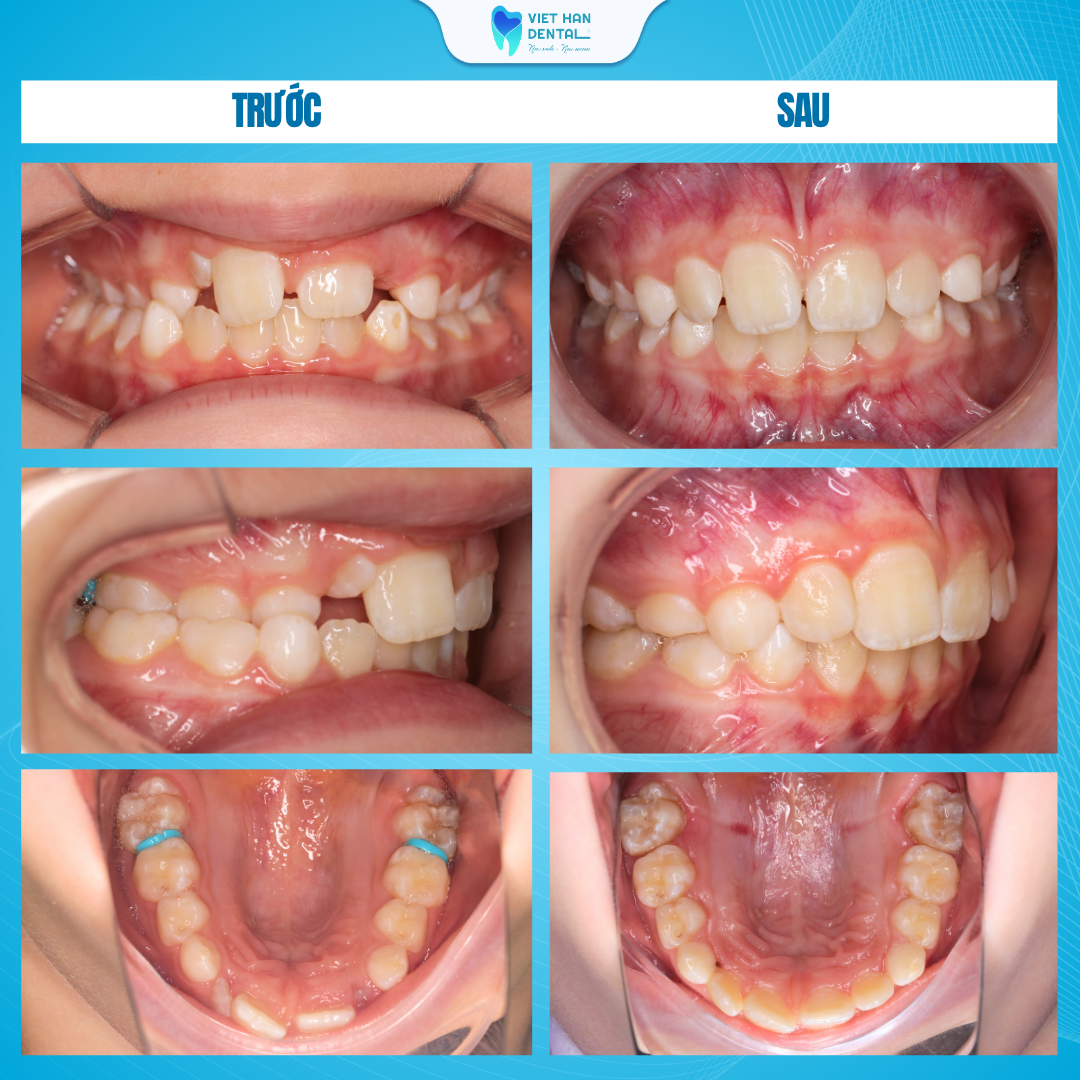 Hình ảnh răng khách hàng trước và sau khi niềng răng tăng trưởng tại Nha khoa Việt Hàn