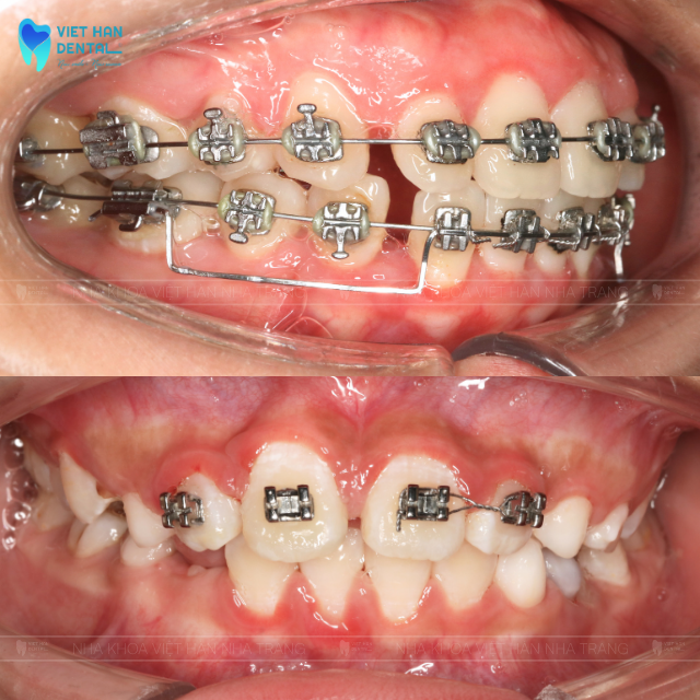 Niềng răng mắc cài kim loại tự buộc