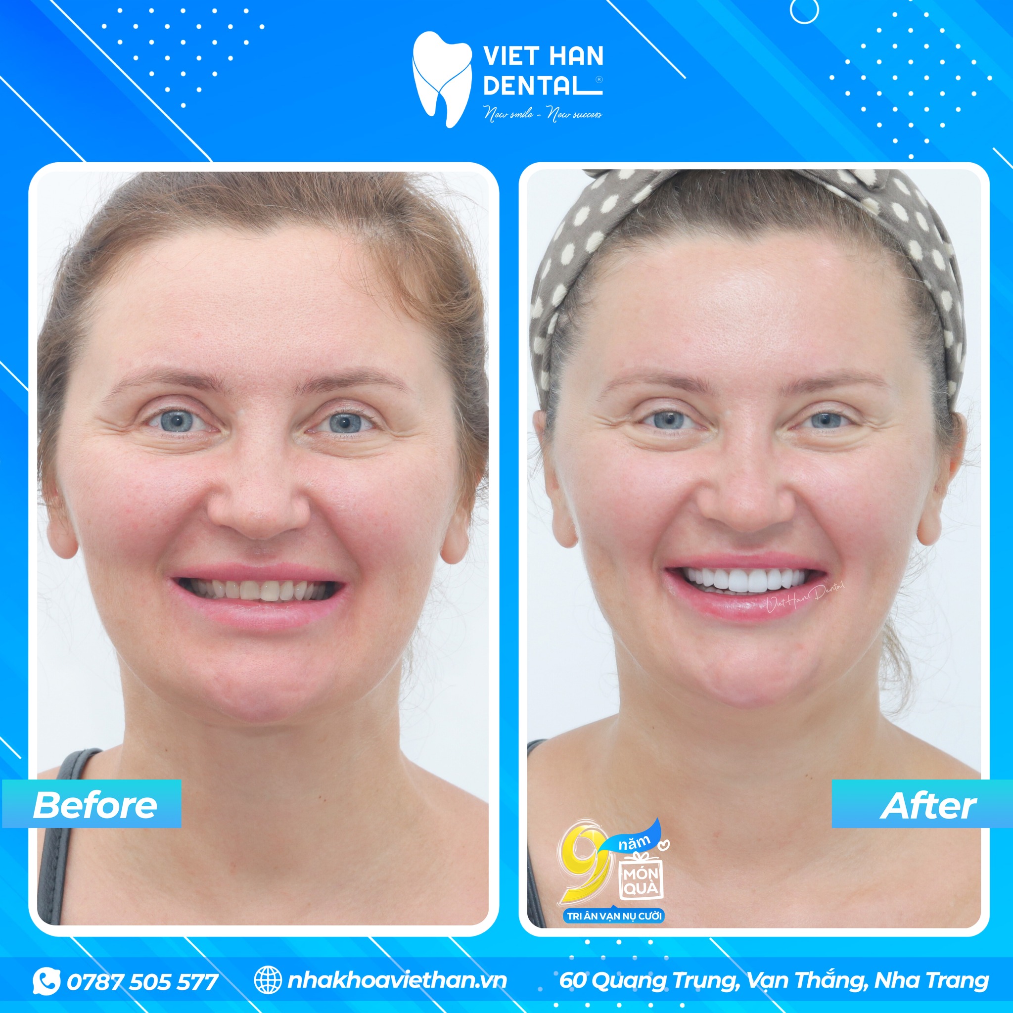 Hình ảnh khách hàng trước và sau khi dán răng sứ Veneer tại Nha khoa Việt Hàn