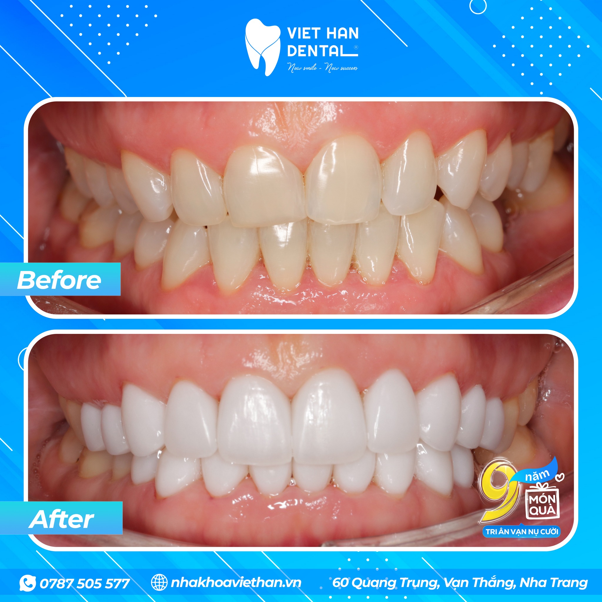 Hình trước và sau khi dán răng Veneer tại Nha khoa Việt Hàn