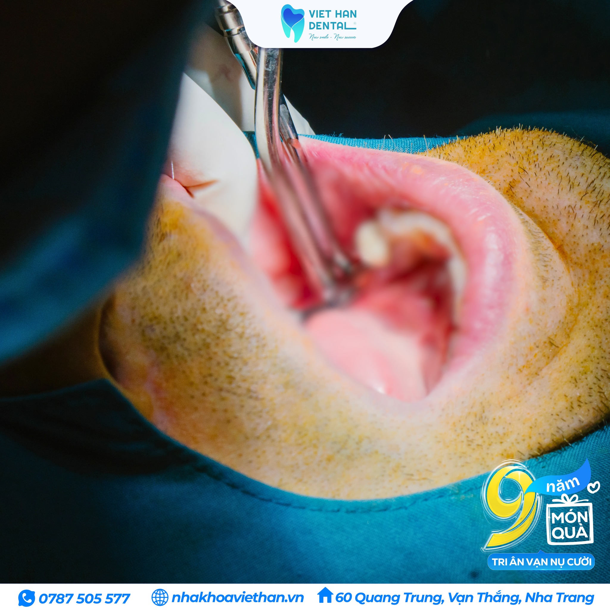 Cấy ghép Implant – Giải pháp hiện đại cho mất răng