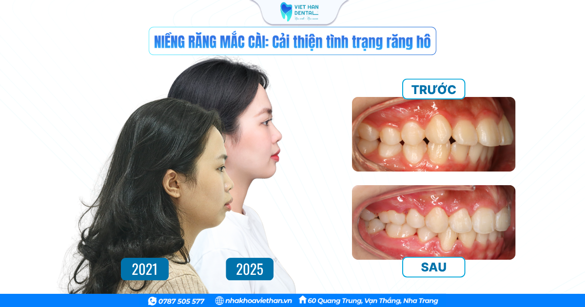 Khách hàng trước và sau niềng răng tại Nha khoa Việt Hàn