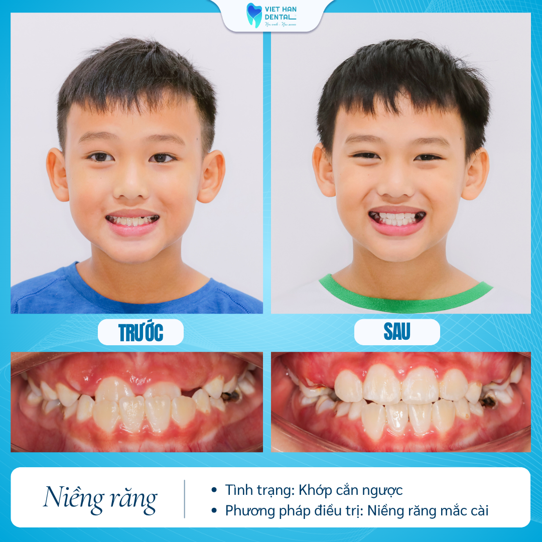 Niềng răng cải thiện tình trạng khớp cắn ngược tại Nha khoa Việt Hàn