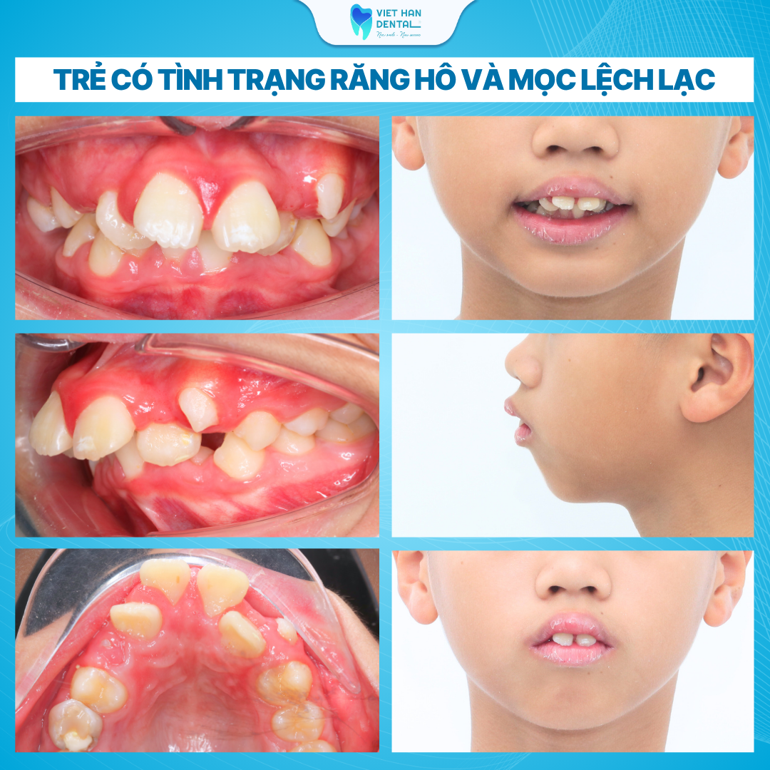 Trẻ có tình trạng răng hô và mọc lệch lạc