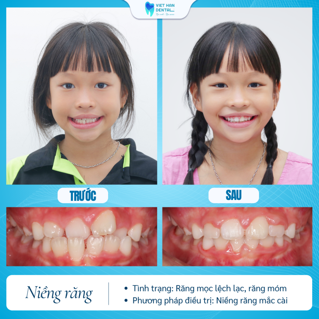 Khách hàng trước và sau khi niềng răng tăng trưởng tại Nha khoa Việt Hàn