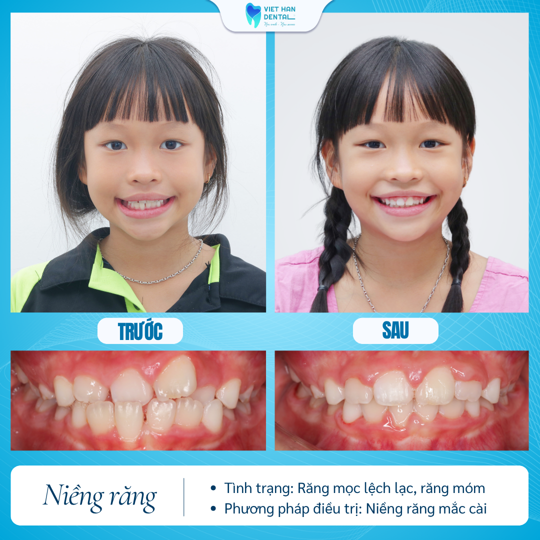 Niềng Răng Tăng Trưởng (3)