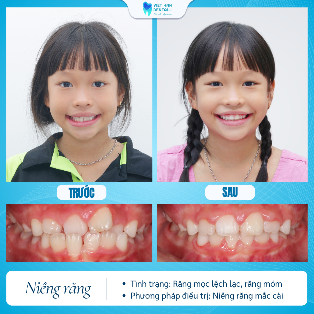 Khách hàng nhí niềng răng tăng trưởng tại Nha khoa Việt Hàn