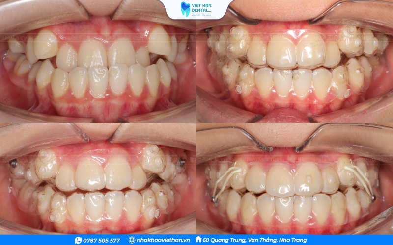 Niềng răng bằng khay trong suốt Invisalign