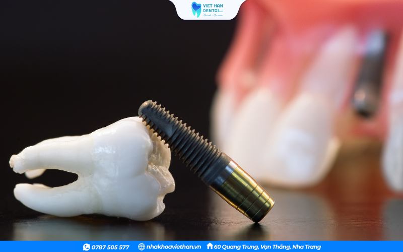 Trồng răng Implant thay thế răng thật đã mất