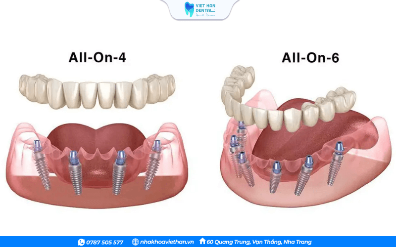 Trồng răng toàn hàm All - on 4 và All- on 6